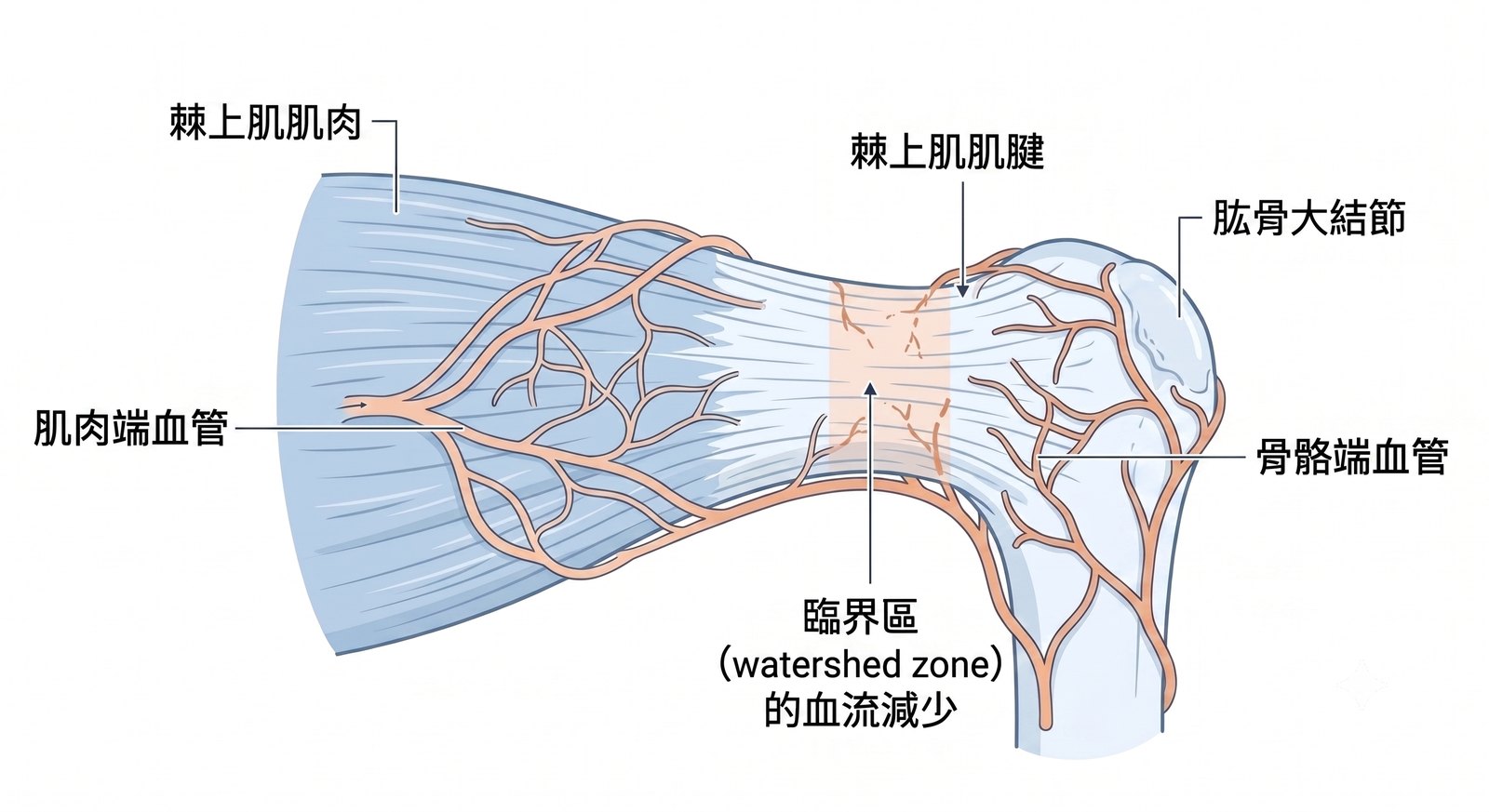 棘上肌腱的「臨界區」——肌肉端與骨骼端血管的分水嶺，血流相對稀少、自我修復困難。